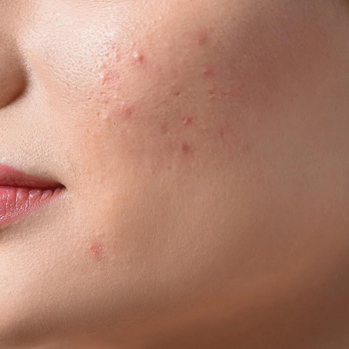 the 7 best clarifying skin care picks | acne · congestion · pores · breakouts
