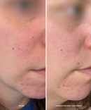 Take Control™ Salicylic + 10% Azelaic Acid Clarifying Serum-4