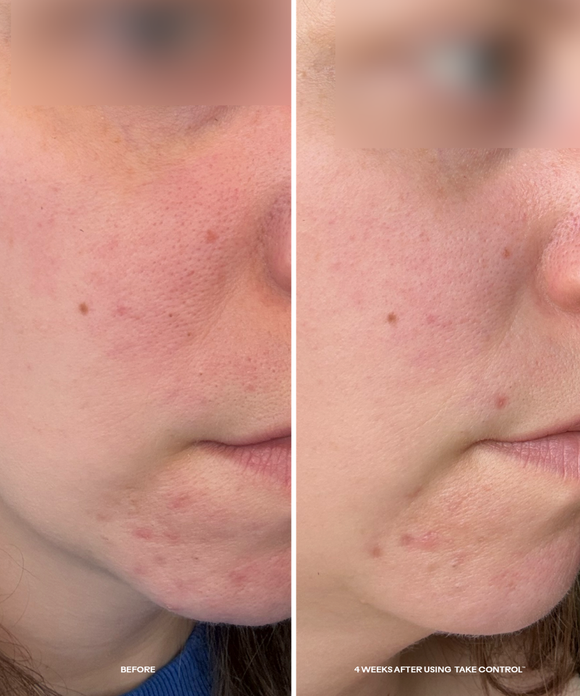 Take Control™ Salicylic + 10% Azelaic Acid Clarifying Serum