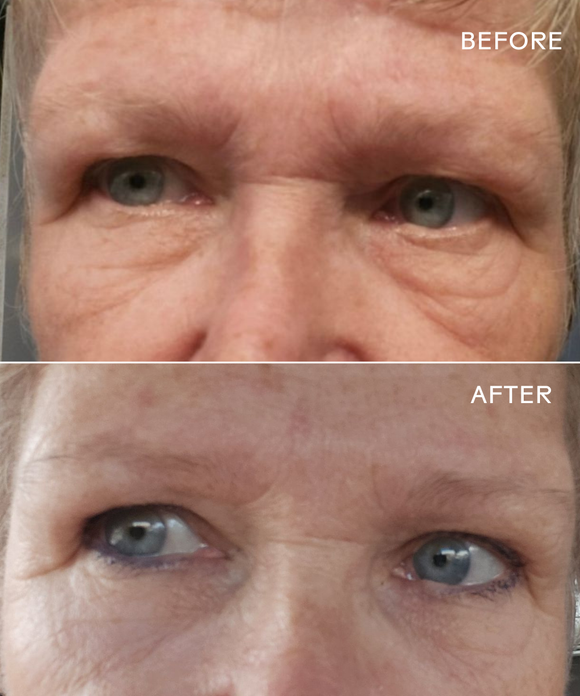 EyeHero™ Bio-Retinol Smoothing Eye Cream