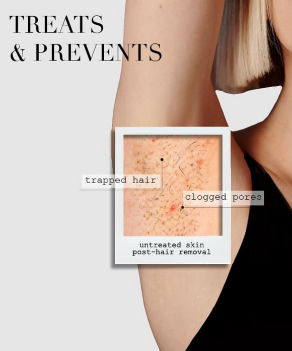 The Ingrown Bar - Kaia Naturals